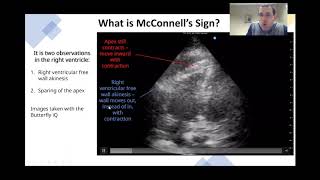 Saddle PE Apical 4 chamber US JETem 2019 [upl. by Scrivens]