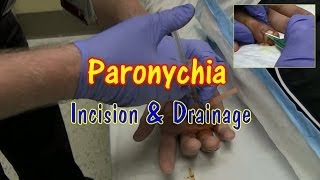 Paronychia Incision and Drainage [upl. by Berenice]