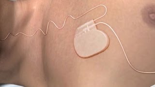 How to Use the Aerobika Oscillating Positive Expiratory Pressure Therapy System [upl. by Padgett84]