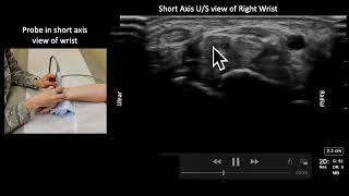 Median Nerve Anatomy and USGuided Injection [upl. by Nafets]