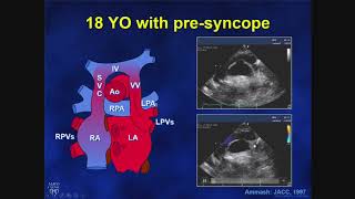 Tetralogy of Fallot 5 chamber view [upl. by Atiken]