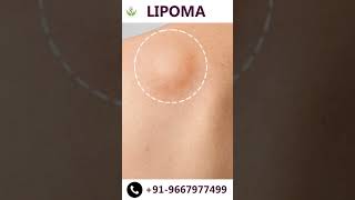 What is Lipoma and how is it treated  Watch NOW  Care Well Medical Centre shorts [upl. by Claudio]