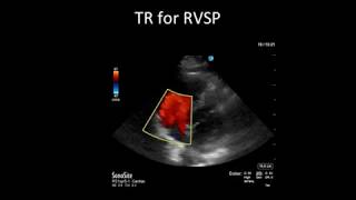 Principles of Doppler Ultrasound [upl. by Enrol]