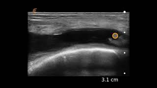 Knee Effusion Ultrasound Image Interpretation [upl. by Engdahl95]