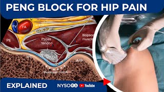 PENG BLOCK FOR HIP PAIN  NYSORAs Regional Anesthesia Clinical Cases [upl. by Aikemaj]