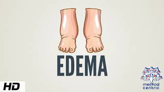 Edema Causes Signs and Symptoms Diagnosis and Treatment [upl. by Aven]