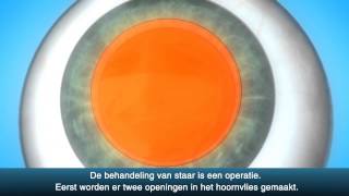 Staaroperatie cataract  OLVG Oogheelkunde [upl. by Sioled]