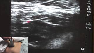 Ultrasound Guided Fascia Illiaca  SSRAUSAcom [upl. by Madonia]