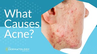 What Causes Acne  Explained by Dermatologist [upl. by Stallworth]