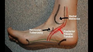 Posterior Tibial Tendinitis Evaluation with Paul Marquis PT [upl. by Howlend212]