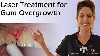 Laser Treatment for Gum Overgrowth [upl. by Starlin]