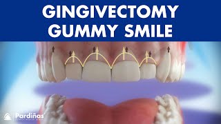 Gingivectomy  Treatment for gummy smile © [upl. by Amak]