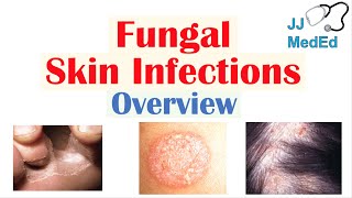 Overview of Fungal Skin Infections  Tinea Infections [upl. by Ultima336]