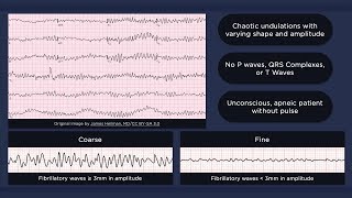 Ventricular Fibrillation ECG [upl. by Airlie]