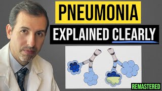 Pneumonia Explained Symptoms Diagnosis Labs Treatment [upl. by Neros]