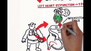 Pulmonary edema USMLE step 1 [upl. by Chiarra]