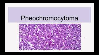 Pheochromocytoma [upl. by Inimod231]