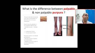 Whats the difference between palpable amp non palpable purpura platelet coagulation vascular cause [upl. by Eleahcim]