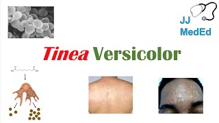 “Fungal Skin Infection of Many Colors” Tinea Versicolor  Pathogenesis Symptoms and Treatment [upl. by Annohs]