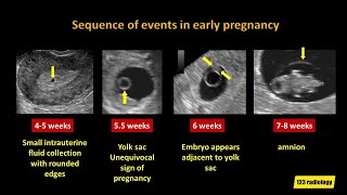 Early Pregnancy Failure A simplified Ultrasound Approach [upl. by Hotchkiss713]