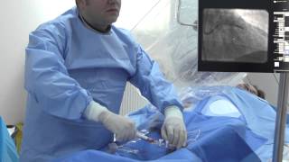 ARES  Angioplastie coronariana cu stent bioresorbabil Absorb  Dr Roberto Haret [upl. by Ashlie]