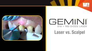 Gemini Clinical – Gingivectomy [upl. by Creigh397]