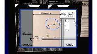 stereotaticCoreBiopsy [upl. by Atekal]