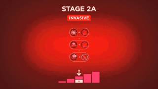 Beyond The Shock  Chapter 5  Types amp Stages  Stage 2 Breast Cancer [upl. by Einon]