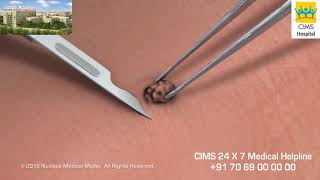 Skin Biopsy Hindi  CIMS Hospital [upl. by Arahsak]