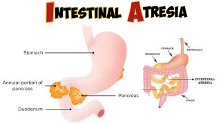 Intestinal atresia amp stenosis [upl. by Naiditch]