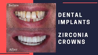 Dental Implants amp Zirconia Crowns Patient Review [upl. by Gwendolin]