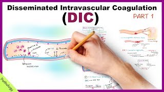 DIC Disseminated Intravascular Coagulation  Part 1 [upl. by Loriner]