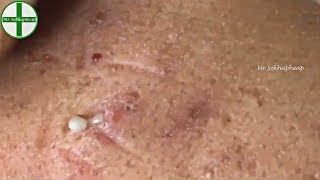 Deep Whiteheads Removal On Face  Acne Treatment 171112 [upl. by Foskett673]