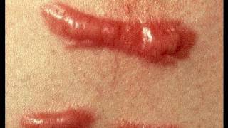 DermTV  How to Treat a Keloid Scar DermTVcom Epi 279 [upl. by Magan]