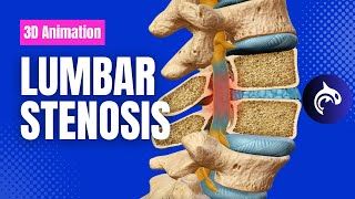 Lumbar Stenosis  3D Animation [upl. by Enyt]