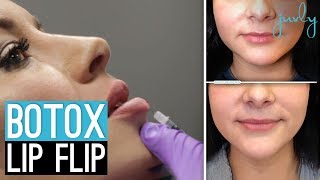 Experience How Botox Lip Flip Actually Works Juvly Aesthetics [upl. by Macpherson609]