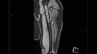 Conventional Chondrosarcoma Humerus [upl. by Urial]