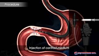 Pyloric Stent [upl. by Noram718]