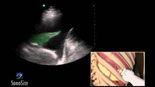 How To Ultrasound Guided Thoracentesis Exam 3D Video [upl. by Aneeuqal]