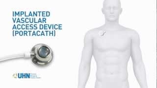 PortaCath Implanted Vascular Access Device [upl. by Terpstra706]