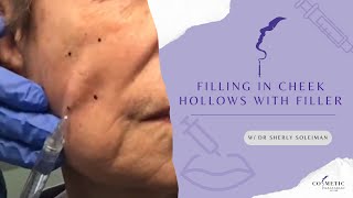 Filling in Cheek Hollow With Fillers [upl. by Booma]