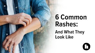 6 Common Rashes And What They Look Like  Healthline [upl. by Annadiane537]