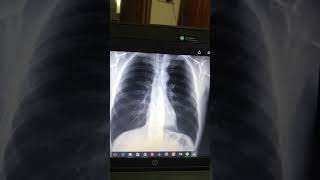 Pleural Effusion Final prof Xray interpretation [upl. by Donoho]