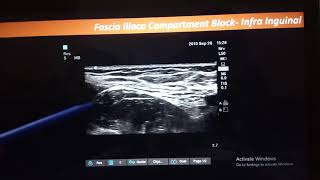 Fascia Iliaca Compartment Block [upl. by Januisz]