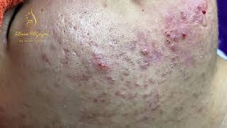 Blackheads Removal 333a  Loan Nguyen [upl. by Ahsilrae345]