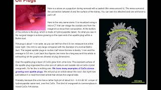 BRUSHITE STONE DISEASE [upl. by Sitarski]