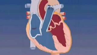 Tetralogy of Fallot [upl. by Icnan]