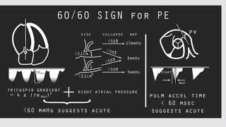 Acute Pulmonary Embolism [upl. by Sivaj]