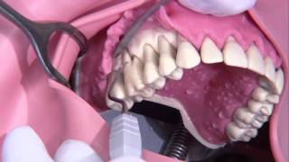 Periodontal surgery Modified Widmann flap [upl. by Cung471]