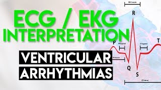 Ventricular Arrhythmias  ECG EKG Interpretation Part 5 [upl. by Ecinom156]